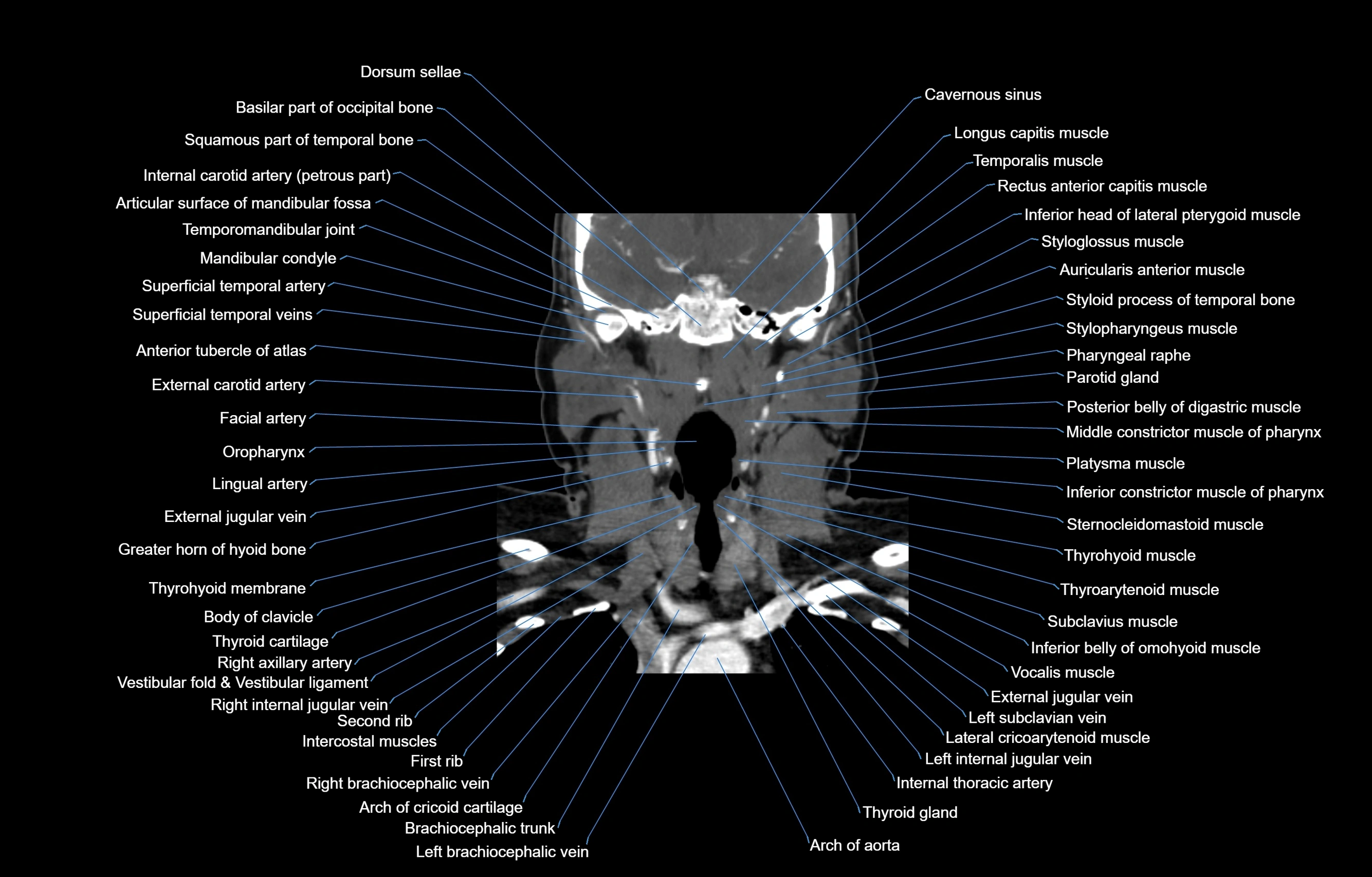 CT Neck coronal  cross sectional anatomy labelled 3D  radiology  image-00034.webp